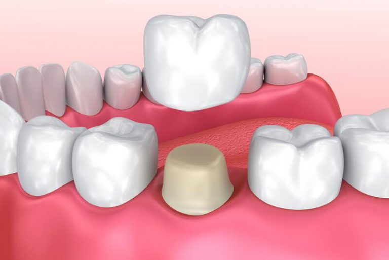 Răng sứ có độ bền cao đồng thời ít gây kích ứng